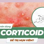 Có nên dùng corticoid để trị mụn viêm?