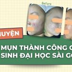 Câu chuyện trị mụn thành công của nữ sinh Đại học Sài Gòn tại Doctor Acnes