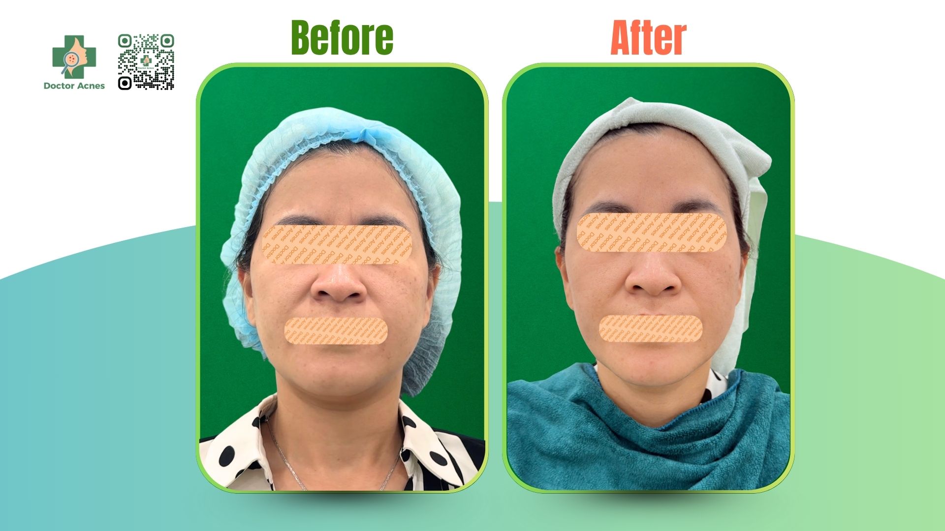 cls tiêm trẻ hóa thành công