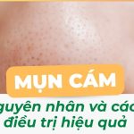 Mụn cám là gì? Nguyên nhân và cách điều trị hiệu quả