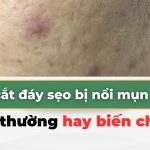 Sau cắt đáy sẹo bị nổi mụn viêm: bình thường hay biến chứng?