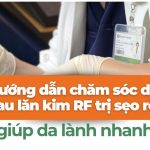Hướng dẫn chăm sóc da sau vi kim RF trị sẹo rỗ giúp da lành nhanh