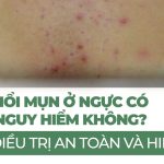 Nổi mụn ở ngực có nguy hiểm không? Cách điều trị an toàn và hiệu quả
