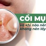 Cồi mụn là gì và khi nào nên hoặc không nên lấy cồi mụn?