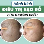 Hành trình điều trị sẹo rỗ của Thượng Triều: sẹo hình thành từ tuổi dậy thì và quyết định điều trị khi bước vào môi trường làm việc