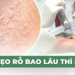 Trị sẹo rỗ bao lâu thì khỏi?