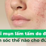Mặt nổi mụn lấm tấm do đâu và chăm sóc thế nào cho đúng?