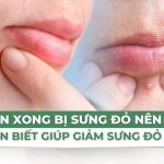 Nặn mụn xong bị sưng đỏ nên làm gì? 6 điều cần biết giúp giảm sưng đỏ hiệu quả