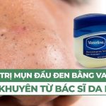 Có nên trị mụn đầu đen ở mũi bằng Vaseline? Lời khuyên từ Bác sĩ Da liễu
