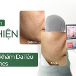 Hành trình cải thiện sẹo tại Phòng khám Da liễu Doctor Acnes
