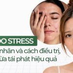 Mụn do stress: nguyên nhân và cách điều trị, ngăn ngừa tái phát hiệu quả