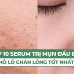 Review top 10 serum trị mụn đầu đen và thu nhỏ lỗ chân lông tốt nhất hiện nay
