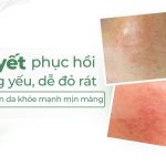 Bí quyết phục hồi da mỏng yếu, dễ đỏ rát giúp lấy lại nền da khỏe mạnh mịn màng