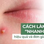 Cách làm mụn nhanh chín, hiệu quả và đơn giản tại nhà