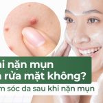 Sau khi nặn mụn có nên rửa mặt không? Cách chăm sóc da sau khi nặn mụn