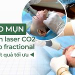 Trị sẹo mụn nên chọn laser CO2 hay deep fractional để đạt kết quả tối ưu?