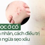 Mụn bọc ở cổ: nguyên nhân, cách điều trị và ngăn ngừa sẹo xấu