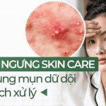 Vì sao ngưng skincare da bị bùng mụn dữ dội và cách xử lý?