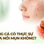 Giải đáp: ăn trứng cá có thực sự khiến da nổi mụn không?