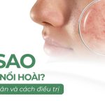 Tại sao mụn cứ nổi hoài? Nguyên nhân và cách điều trị