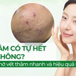 Sẹo thâm có tự hết không? Cách làm mờ vết thâm nhanh và hiệu quả nhất