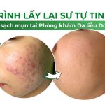 Hành trình lấy lại sự tự tin cùng làn da sạch mụn tại Phòng khám Da liễu Doctor Acnes