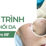 Quá trình phục hồi da sau vi kim RF