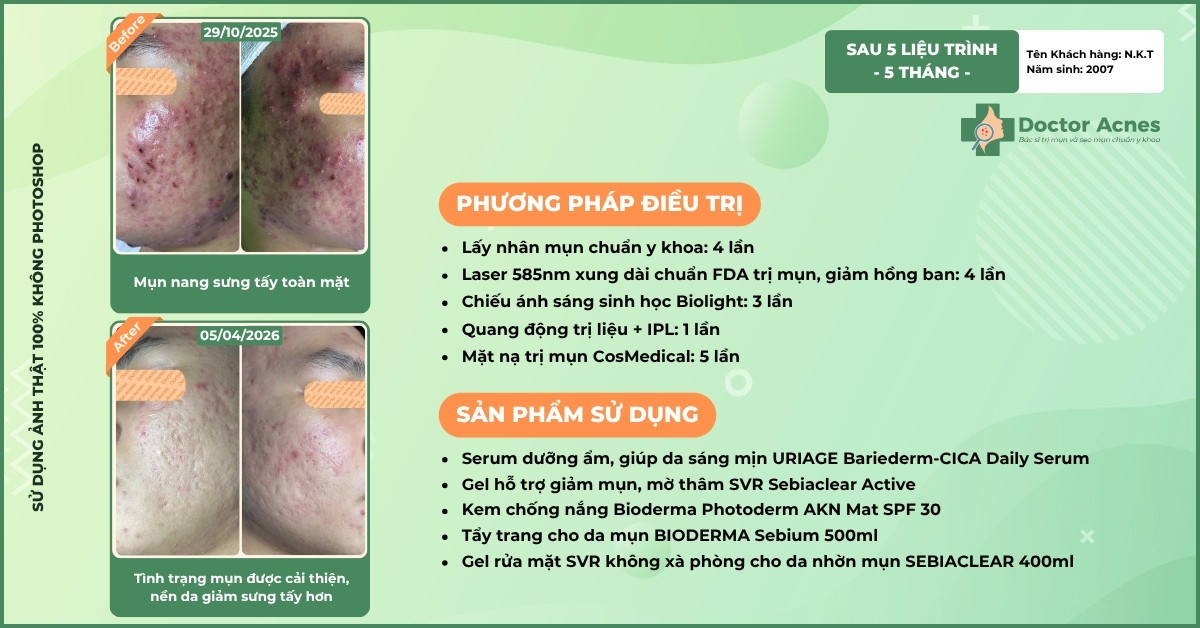 Ca lâm sàng điều trị mụn thành công tại Doctor Acnes