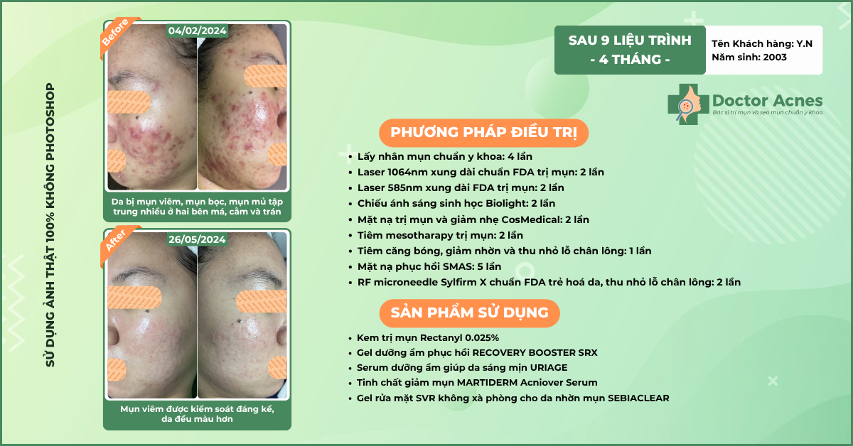 Ca lâm sàng điều trị mụn tại Doctor Acnes