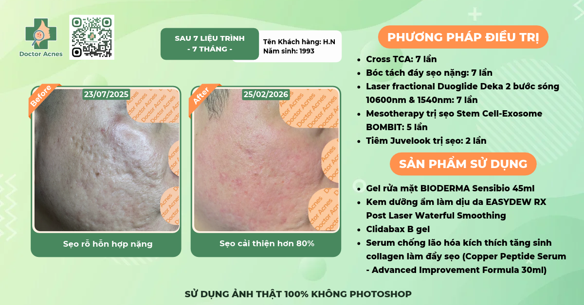 ca lâm sàng trị mụn tại Doctor Acnes
