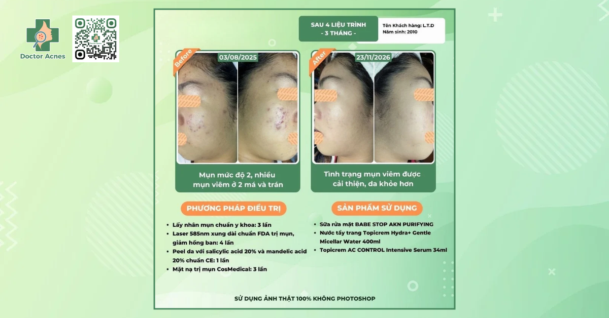 ca lâm sàng trị mụn tại Doctor Acnes