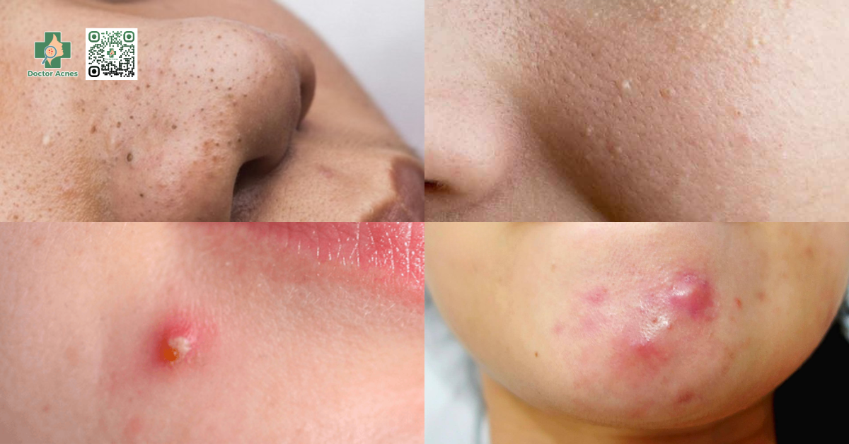 các loại mụn đặc trưng trên da