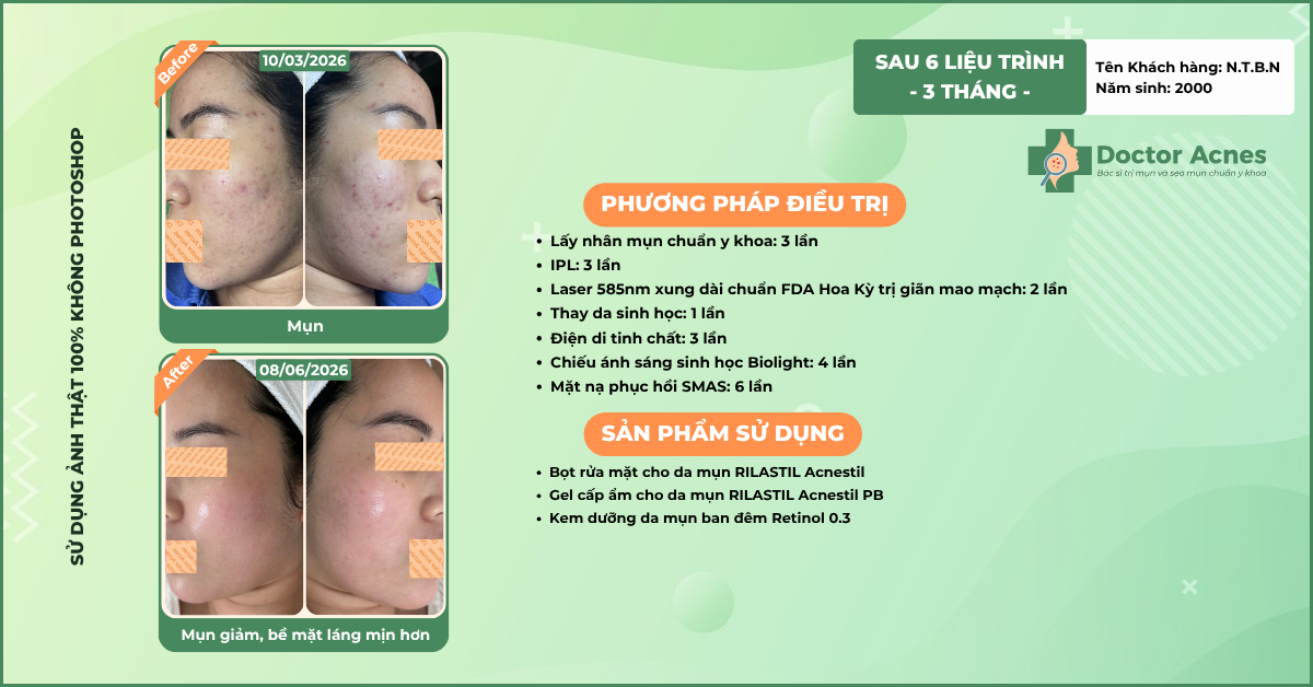 ca lâm sàng trị mụn tại Doctor Acnes