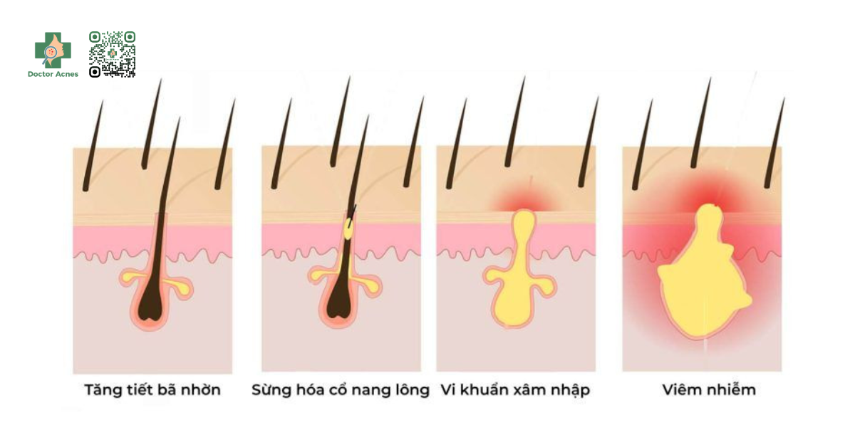 cơ chế hình thành mụn trứng cá
