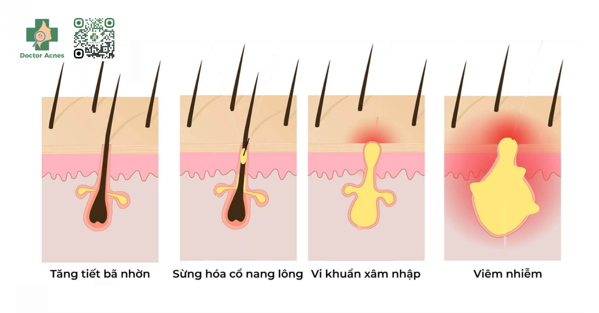 cơ chế hình thành mụn