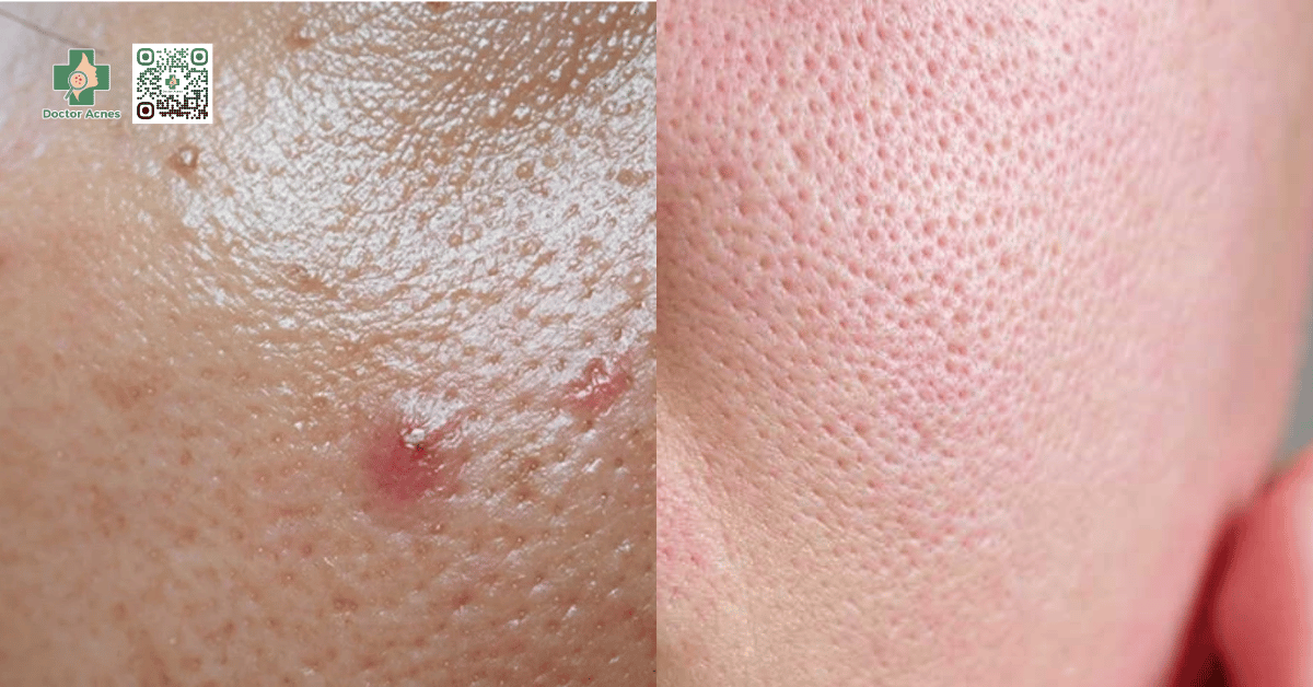 da bóng nhờn (bên trái) và lỗ chân lông (bên phải)