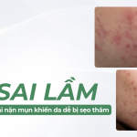 6 sai lầm khi nặn mụn khiến da dễ bị sẹo thâm