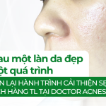 Đằng sau một làn da đẹp là cả một quá trình. Cùng nhìn lại hành trình cải thiện sẹo rỗ của khách hàng T.L tại Doctor Acnes