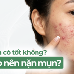Nặn mụn có tốt không? Khi nào nên nặn mụn?